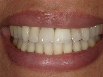after implant restoration