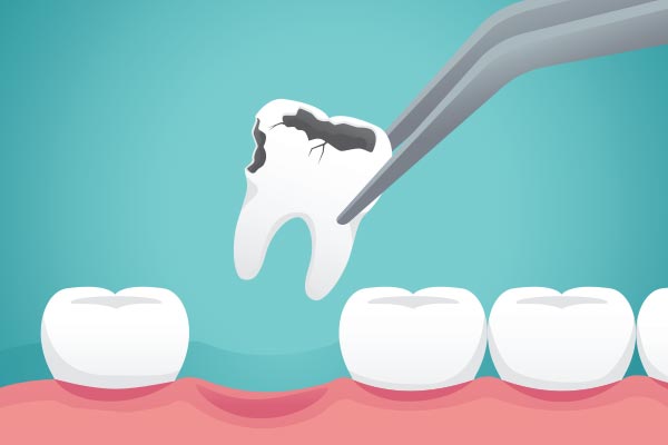Ask a General Dentist: What Happens to Your Tooth After Extraction from Ohio Cosmetic Dentists in Columbus, OH