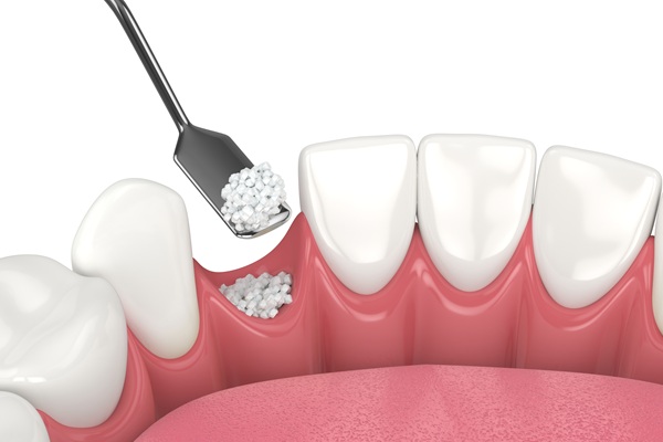Bone Grafting For Dental Implant Placement