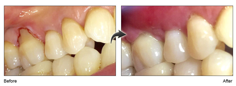 Chao-Pinhole-Surgical-Technique