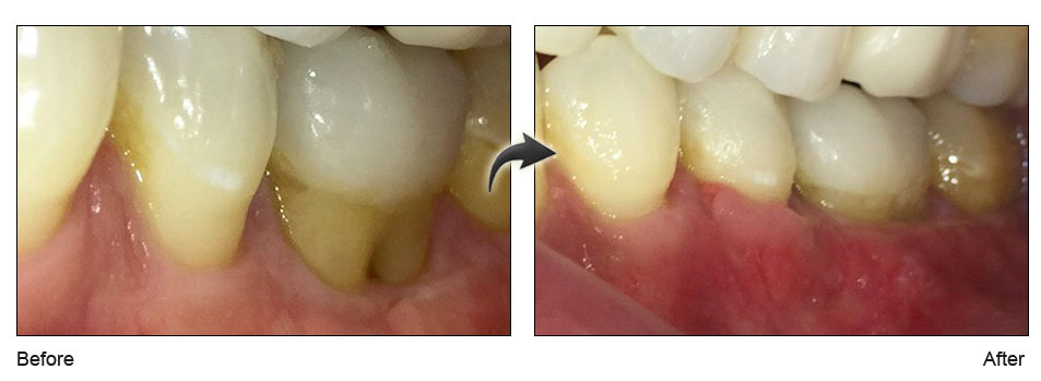 Chao-Pinhole-Surgical-Technique