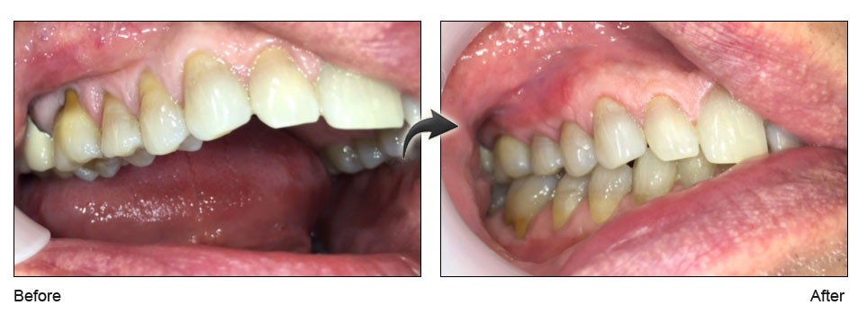 Chao-Pinhole-Surgical-Technique