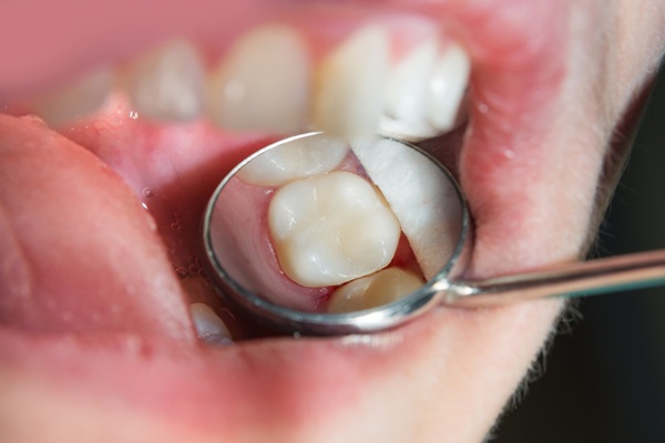 How To Know If Composite Fillings Are Right For You