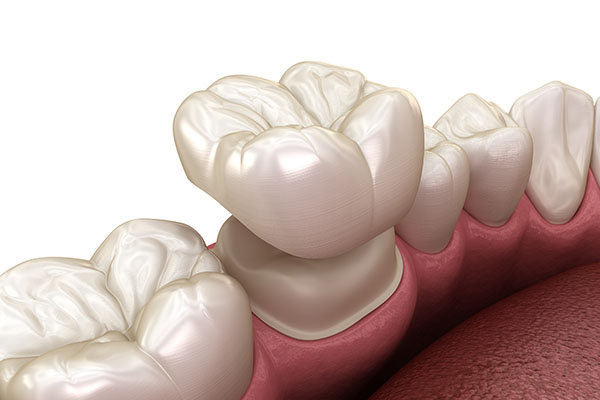 What Can Dental Crowns Do for Your Oral Health Issues? from Ohio Cosmetic Dentists in Columbus, OH