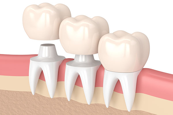 Three Tips To Deal With A Loose Dental Crown