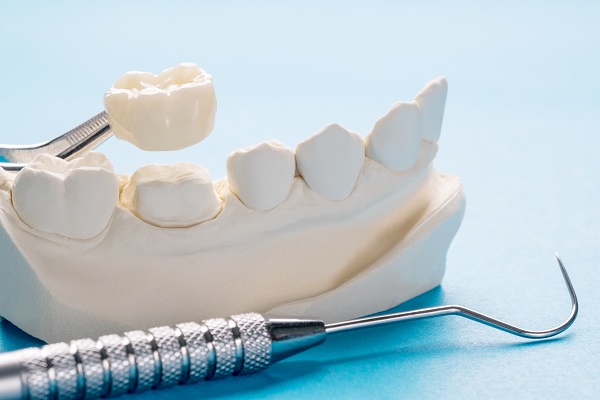 Dental Crowns As A Cosmetic Treatment