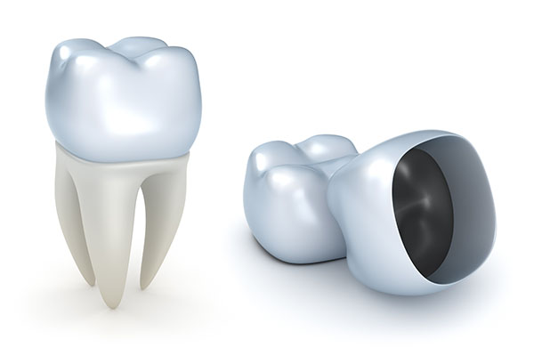 Is A Dental Crown Recommended For Dealing With A Cracked Tooth?