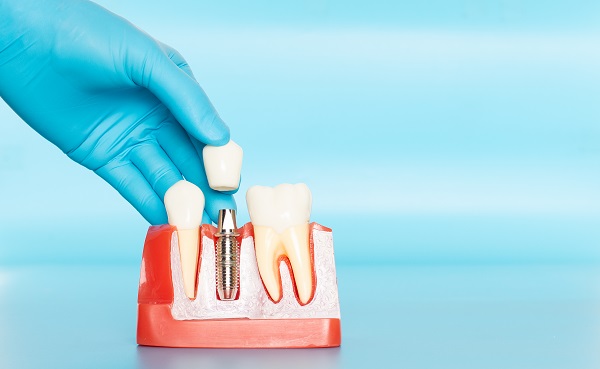 When Would You Need Dental Implants?