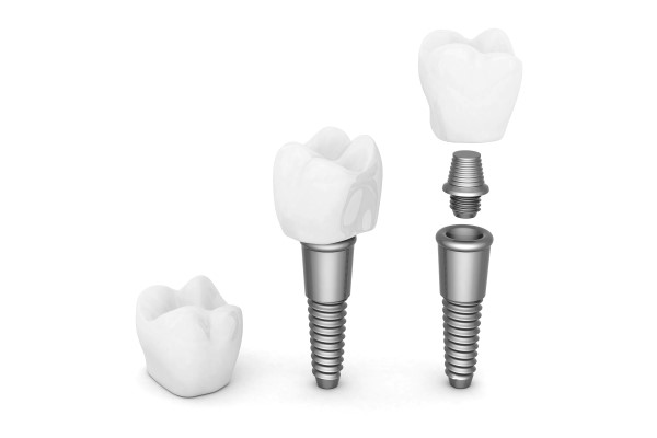Dental Implant Restoration To Replace A Missing Tooth