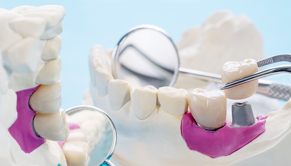 Dental Implant Restoration: Prosthetic Root And Crown