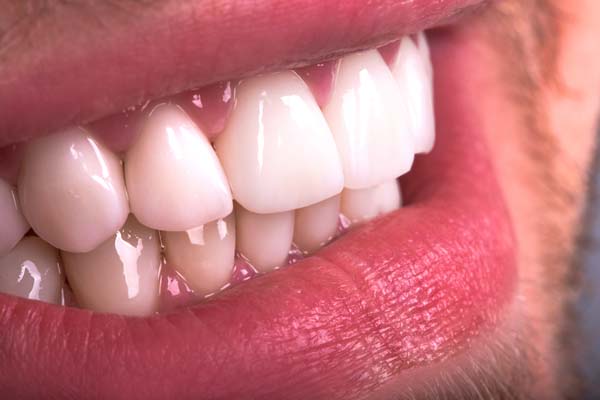 Front Teeth Repair: Bonding, Crowns or Veneers? - Healthy Smiles Family  Dentistry LLC LaGrange Georgia