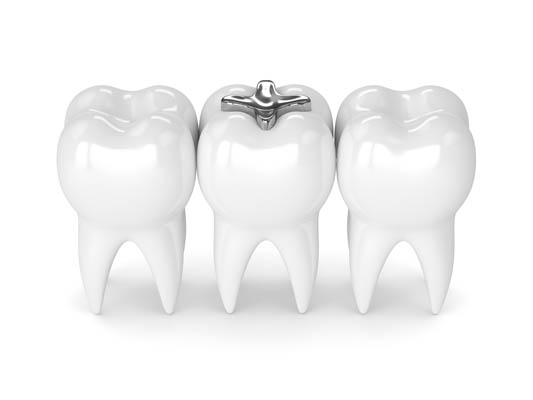 How Dental Sealants Can Help A Damaged Tooth