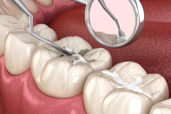 Important Facts About Dental Sealant Placement