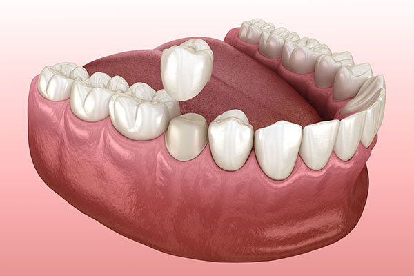 Does A Dental Crown Help After A Root Canal?