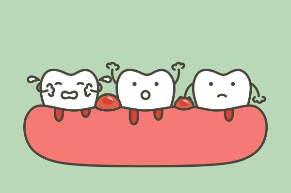 Antibiotics For Emergency Dental Abscess