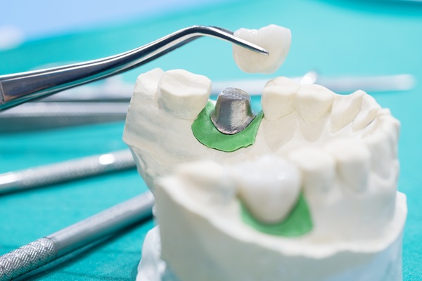 Implant Crowns: A Durable And Natural Looking Solution For Tooth Restoration