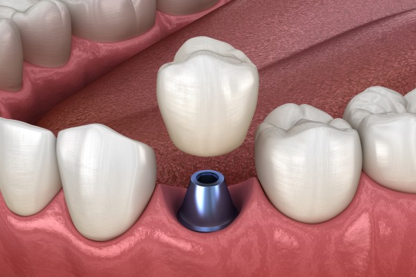 Implant Dentist Columbus, OH