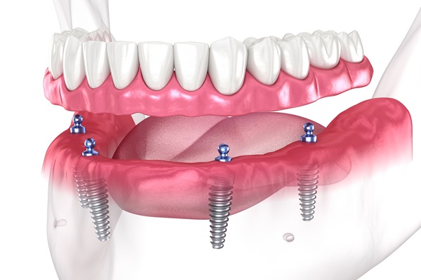 Implant Overdentures From An Implant Dentist