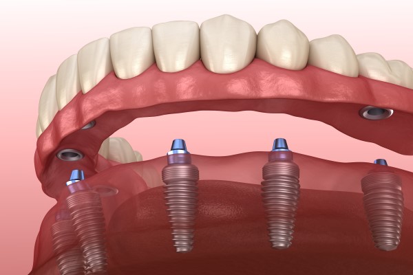 Implant Supported Dentures Columbus, OH