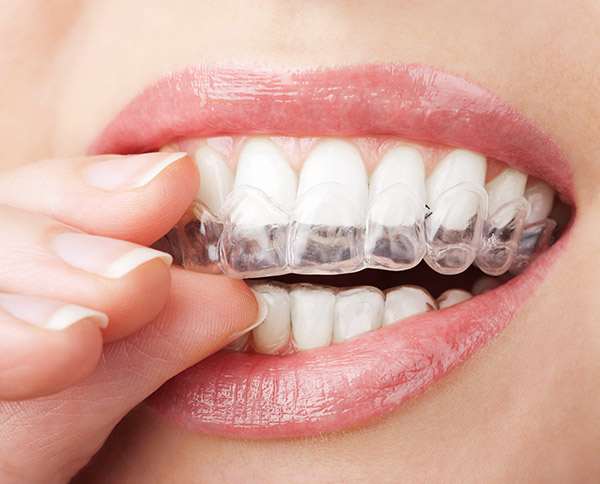 Invisalign® Dentist In Columbus