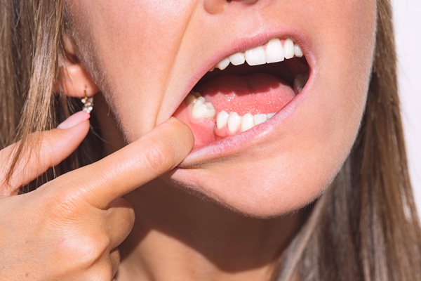 Replacing A Missing Tooth: Why It Is Necessary And How We Can Help