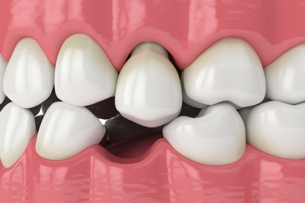 Options For Replacing Missing Teeth: Avoid A Possible Dental Emergency