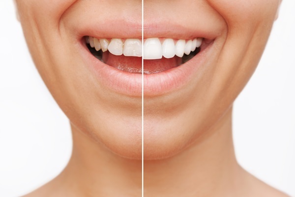 What To Consider When Getting A Smile Makeover