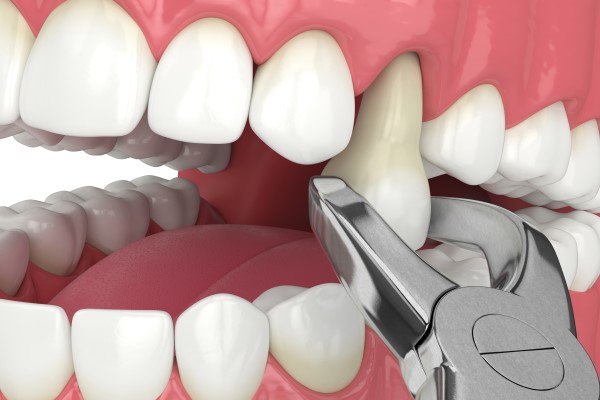 What To Expect During A Tooth Extraction