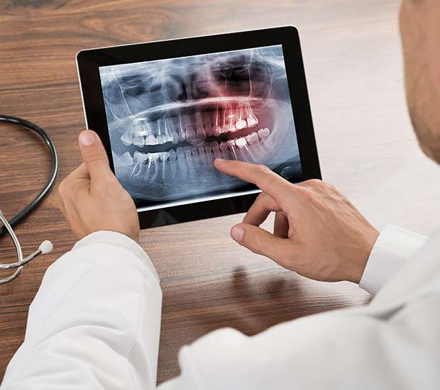 Columbus Types of Dental Root Fractures