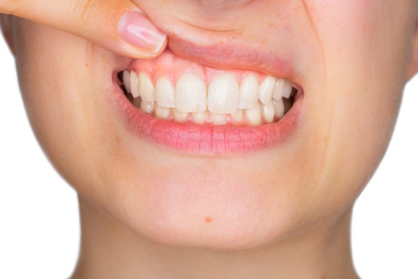 How Does Gum Contouring Change The Shape Of Gums?